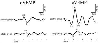 Uneven Effects of Sleep Apnea on Semicircular Canals and Otolithic Organs